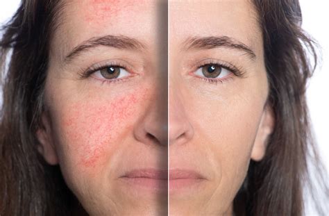 Rosacea Laser Treatment Rosacea Laser Therapy 2 Treatments Columbia