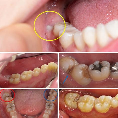 Why Does My Mouth Hurt Months After Wisdom Teeth Removal - Infoupdate.org