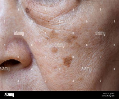Dark cheek spot hi-res stock photography and images - Alamy