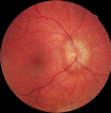 Optic Disc Swelling In One Eye at Harrison Leschen blog