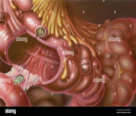 With diverticulitis hi-res stock photography and images - Alamy