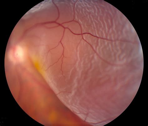 Retinal Detachment: Causes, Symptoms, and Treatments