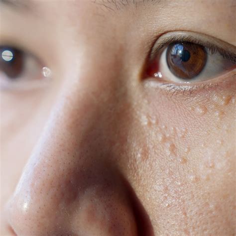 What Are Milia Spots? A Dermatologist Explains The Common Aging Skin Condition And How To Treat ...