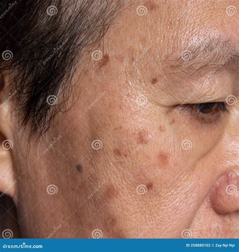 Small Brown Patches Called Age Spots on Face of Asian Elder Man. they are Also Called Liver ...