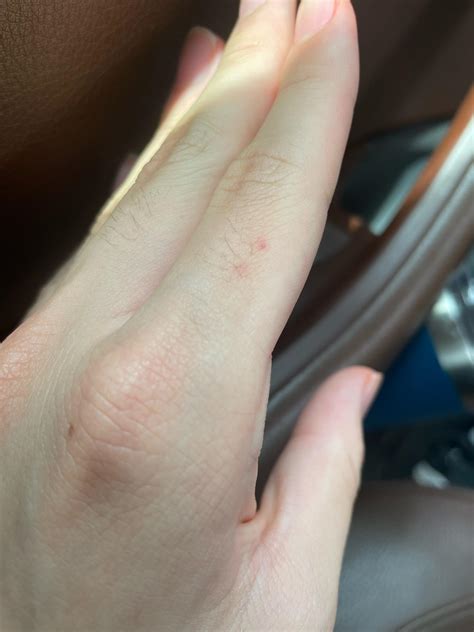 Could this be a bat bite? : r/rabies