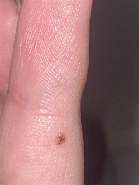 Mole with dark centre on finger. Should I get it checked? : r/Melanoma