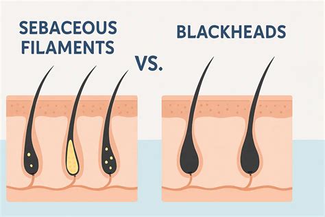 Sebaceous Filaments Vs. Blackheads: Understanding The Difference – AreoVeda