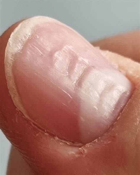 Raised Bumps On Fingernails