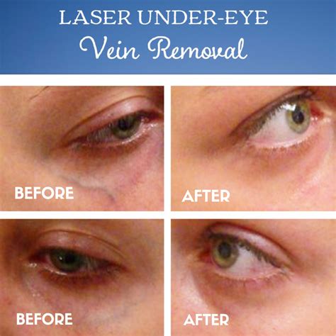 Laser Eyes Veins at Ida Wheeler blog