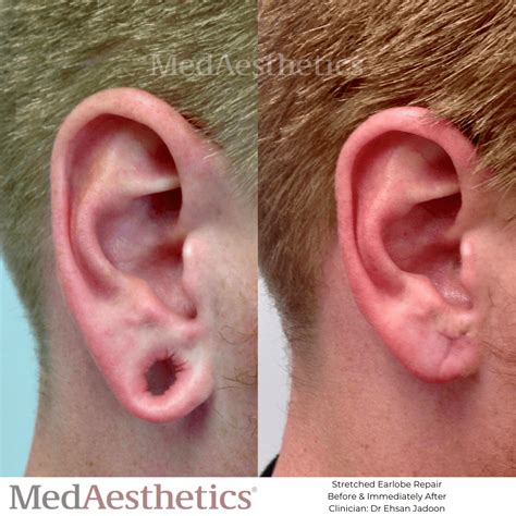 Stretched Earlobe Repair Perth | Torn Earlobes Surgery