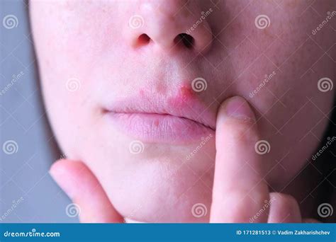 Herpes Virus on Human Lips. Woman Touching Herpes Sore on Lip Mouth ...