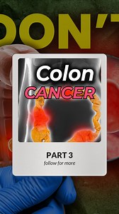 Colon Cancer: Prevention & My Colonoscopy Experience! 😅🔬 Part 3 So I got a colonoscopy... and they filmed me right after, still loopy from sedation. 😂 What Is a Colonoscopy? 🔍 A small scope travels through: External anal sphincter → anal canal → rectum → sigmoid → descending → transverse → ascending colon → cecum! Why It's Worth It ✅ ✅ Best screening tool for colon cancer ✅ No cutting = non-invasive! ✅ Scans for polyps, cancer & more ✅ Very accurate! The Most Important Takeaway 💡 Most peopl