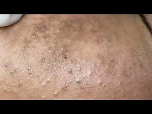 Blackhead removal with NaSa Spa | Satisfying and Relaxation with NaSa Beauty Spa