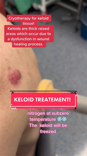 Keloid Treatment: Cryotherapy for Keloid Tissue