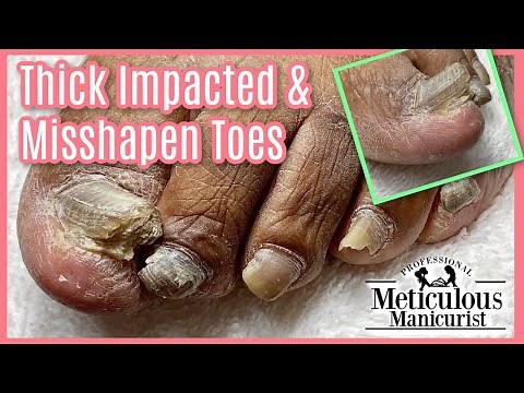 A PEDICURE For TOE NAIL FUNGUS TRANSFORMATION - PART 2