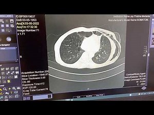 Subcutaneous Emphysema on CT Thorax.