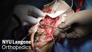 Distal Triceps Tendon Revision Reconstruction Techniques