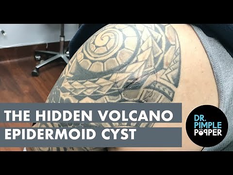 The Hidden Volcano Cyst