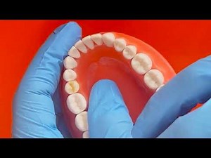 Adex class 2 composite premolar filling