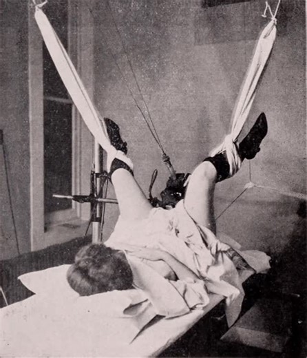 Nurse Chinel on Instagram: "In 1920, this was what “cutting-edge cancer treatment” looked like. A woman lies on a hospital bed, her legs suspended in fabric slings, held aloft not for comfort, but for access. Electrical wires hang overhead. There are no imaging screens. No digital dosimetry. Just a raw beam of radiation crudely aimed at a disease doctors barely understood. She had advanced cervical cancer. By spring, her case was considered hopeless. So physicians tried something radical: intra-