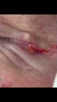 Blackhead extraction around eyes