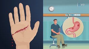 The role of intravenous tirofiban in patients undergoing endovascular treatment for acute intracranial atherosclerotic occlusion - Watch Related Videos