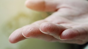 Z dłoni schodzi ci skóra? Smaruj je tym codziennie, a będą gładkie i nawilżone