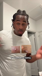 Universal Flare Care is a safe, proven solution for flare-ups! Trusted by 200k+ customers to soothe, heal, and protect even the most sensitive and flare-prone skin. Get it risk-free today! | Mymagichealer | Facebook