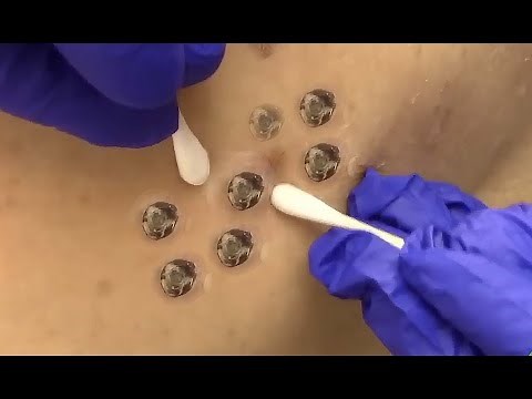 Extreme Blackhead Extraction From Back