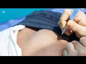 Female patient get Intramuscular injection #iminjection #injection