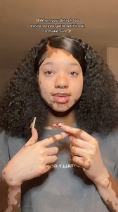 35K views · 827 reactions |  cassmerecassy link in bio ✨ be sure y’all enter the giveaway to win a FREE set ❤️ #fyp #vitiligo | Hebe Belinda | Facebook