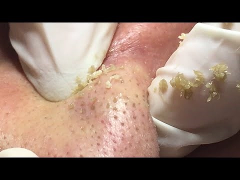 Suri Job 105: EXTRACTION ACNE ON NOSE