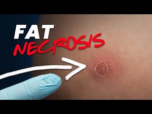 Red Marks After a BBL, Can it be FAT Necrosis? 😱