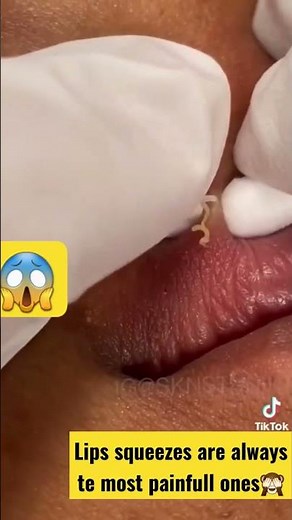 popping huge blackheads and pimples 😱 | pimple popping | best pimple popping videos 2022 | cyst