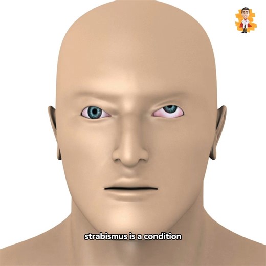 This is how eye surgery for Squint Eyes is performed. #Surgery #Medical #Strabismus | Doctor ASKY