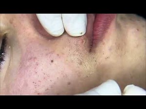 𝑺𝒐𝒐𝒕𝒉𝒊𝒏𝒈 𝑭𝒂𝒄𝒊𝒂𝒍 𝑻𝒓𝒆𝒂𝒕𝒎𝒆𝒏𝒕 𝒇𝒐𝒓 𝑺𝒕𝒓𝒆𝒔𝒔 𝑹𝒆𝒍𝒊𝒆𝒇 - SATISFYING Blackhead Removal