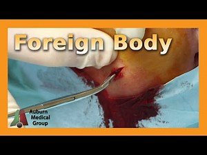 Metal in Your Sole | Auburn Medical Group