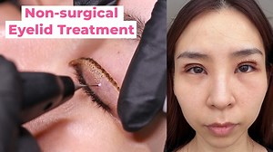 1.5M views · 13K reactions | Fixing My Uneven Eyelids with the Plasma Pen – Before & After! 朗 #eyelids #skincare #beauty | Tina Yong | Facebook