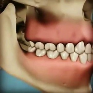 2.3K views | Teeth cleaning (also known as prophylaxis, literally a preventive treatment of a disease) is a procedure for the removal of tartar that may develop even with careful brushing and flossing, especially in areas that are difficult to reach in routine toothbrushing. #harvandental | Harvan Dental Clinic | Facebook