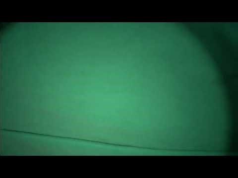 Surgical double ligation of the PDA (mini-thoracotomy)