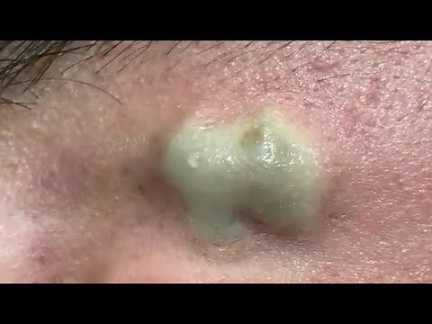 LARGE Blackheads Removal - Satisfying Blackhead 2019 (Part 03)