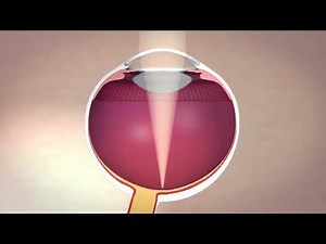 Laser Cataract Surgery with the AMO Catalyst precision laser system at Mann Eye