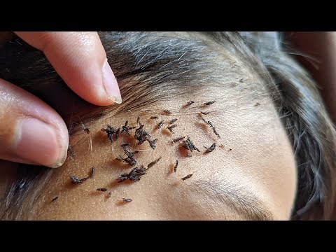 How to remove all of big lice from hair - Getting out many head lice