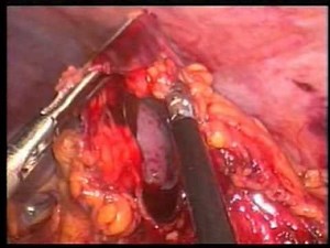 Laparoscopic Total Proctocolectomy