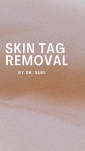 Acrochordons or Skin Tag Removal အသားပိုဖျက်ခြင်း #drsuri #lasercareclinic | Dr Suri