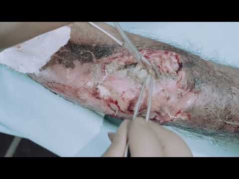 Wound dressing | maggot | biotherapy"Maggot Infection in Humans | Full Medical Case Study"