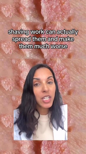 Genital warts called condyloma are caused by HPV and common in sexually active people. We can treat them in office! #wart #HPV #dermatology | Dr. Leela Athalye