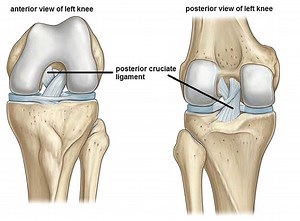 Posterior Cruciate Ligament Tears - From Diagnsosis to Treatment