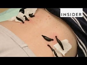 Holistic Center Performs Leech Therapy