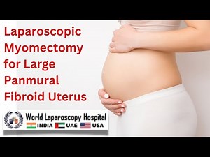 Laparoscopic Myomectomy for Large Panmural Fibroid Uterus: An Ideal Surgical Approach